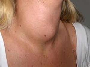 Goiter